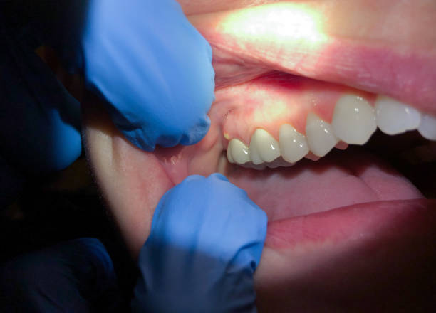 Best Emergency Tooth Extraction in Jones Creek, TX